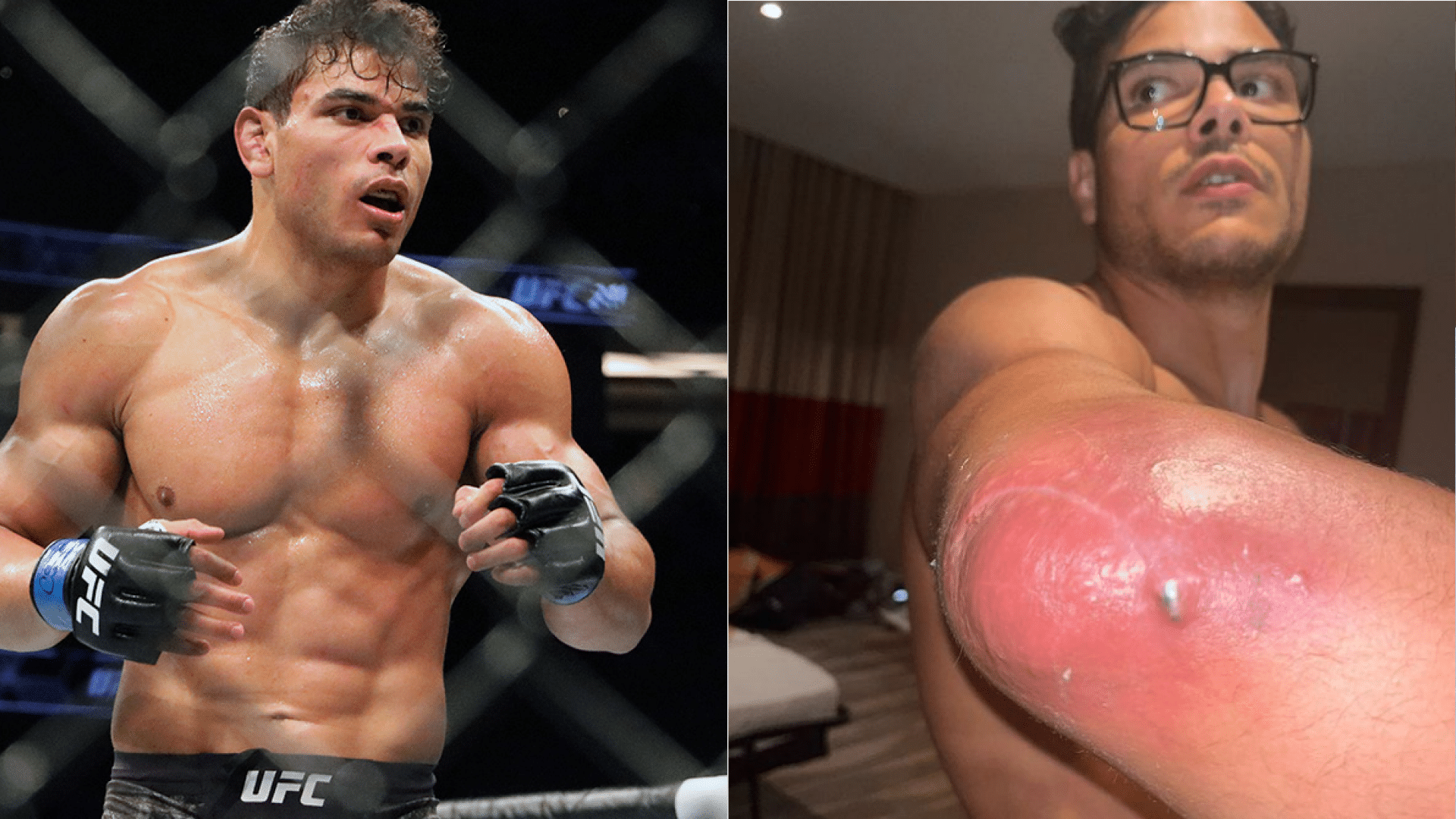 Combattant UFC avec abcès staphylocoque sur le coude